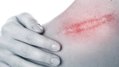 الطريقة المثالية لعلاج الجروح والإصابات حتى لا تترك ندبات