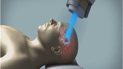 العلاج بالإشعاع البروتوني .. الأكثر أمانًا لعلاج الأمراض السرطانية عند النساء