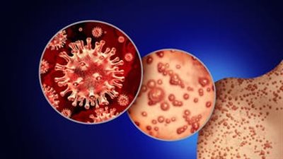 مصر تسجل أول حالة إصابة بفيروس جدري القرود