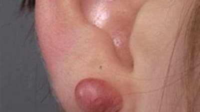 «كفاية خرم واحد».. البريسينج يهددك بأمراض لا يمكن علاجها