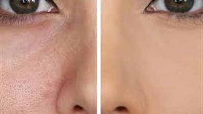 تعرفي على أسباب ظهور المسام الواسعة في البشرة وطريقة العلاج