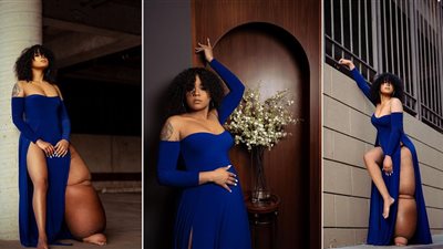 «ماهوجاني» حكاية عارضة أزياء ولدت بحالة نادرة وساق تزن أكثر من 45 كيلوجرام