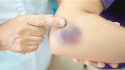 بينها السرطان.. كدمات الجسم قد تكون مؤشرًا لأمراض خطيرة 