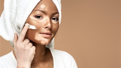 لأول مرة.. علاج موضعي فعال لمرض البهاق