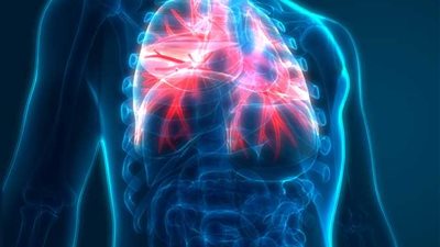 إنفوجراف| تعرفي على أسباب إصابة الأطفال بالالتهاب الرئوي