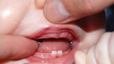 لا تقلقي.. 3 علامات تكشف مرور طفلك بمرحلة التسنين