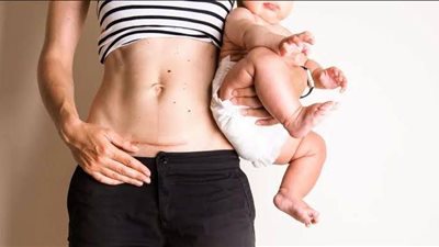 أهمها المشي.. 4 طرق سهلة لشد ترهلات البطن بعد الولادة