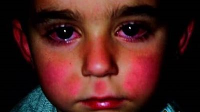 يُصيب الفم واليد والقدم.. احذري فيروس جديد يُهدد الأطفال