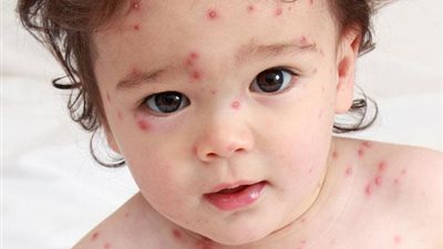  اكتشفيها.. علامات تظهر إصابة طفلك بالجديري المائي