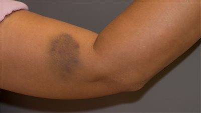 استشاري تكشف علاقة الكدمات الزرقاء في الجسم بالاكتئاب