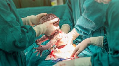 الصحة تحذر من الولادة القيصرية دون مبرر (إنفوجراف)