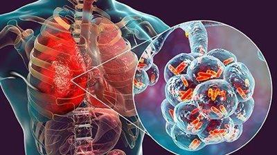«صحة الرئة»| أسباب ضيق الشعب الهوائية والتهاب القصبات (انفوجراف)