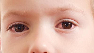 6 علامات تكشف إصابة طفلك بالتهاب الملتحمة الفيروسي