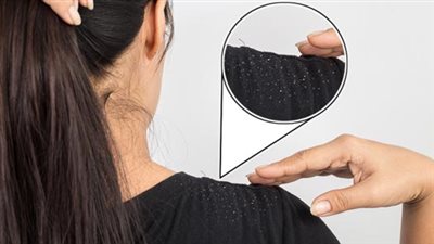 تعرفي على أنواع قشرة الشعر وطرق علاجه نهائيًا