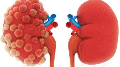 تعرفي على أعراض الفشل الكلوي وأسبابه