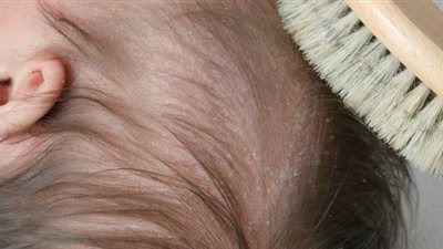 هل تحمي طاقية المهد رأس طفلك؟ وطرق الوقاية