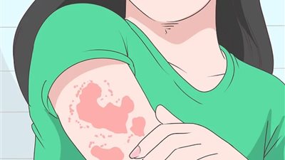 «تسبب الوفاة» تعرفي على أنوع بكتيريا متلازمة الصدمة التسممية