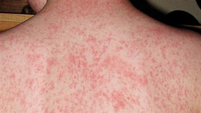 «لا يوجد لها علاج» تعرفي على مضاعفات الحصبة لحماية طفلك