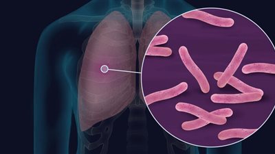 مرض السل وعلاجه وكيفية الوقاية منه «الصحة تجيب بالفيديو»