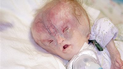 «الشيخوخة عند الولادة» ما هي متلازمة البروجيرويد الوليدية؟