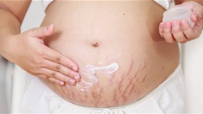  تخلصي من علامات التمدد بعد الحمل بطرق بسيطة