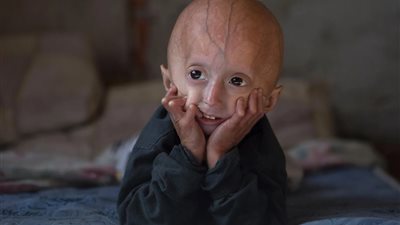 أشهرها مرض باركنسون العائلي| متلازمات البروجيرويد وعلاقتها بـ«الشيخوخة المبكرة»