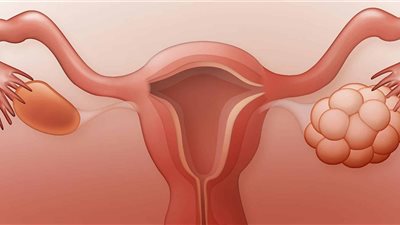 «الأعراض والعلاج» ماذا يعني انفجار كيس المبيض أثناء الحمل؟