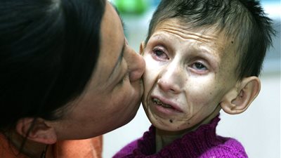 «متلازمة كوكاين» أحد أمراض الشيخوخة التي تقتل الأطفال بعمر 12 عامًا 