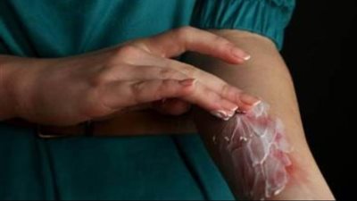 «تدمر البشرة» 6 أخطاء شائعة للتعامل مع الحروق المنزلية تقع فيها النساء 