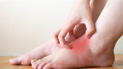 «مرض رينود والسكري» مشاكل تصيب القدمين في فصل الشتاء