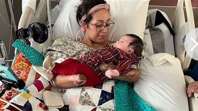 أم تفقد أطرافها الأربعة بسبب إصابتها بتسمم في الدم بعد «ولادة قيصرية»