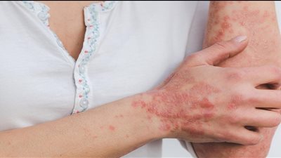 بعد أنباء إصابة شيكابالا | كيف تتجنبي مرض تورم الدم؟