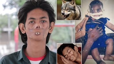 «الفتى الشبح» مراهق هندي أكل وجهه الذئب وتحول إلى أسطورة 