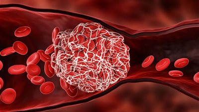 استشاري يوضح فئة «مرضى الجلطات» الممنوعة من الصيام في رمضان 