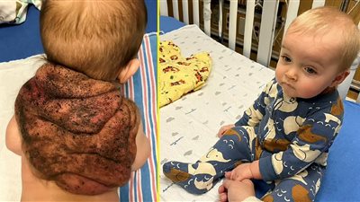 «سلحفاة النينجا الصغيرة» طفل يولد بصدفه على ظهره بسبب خلل جيني 