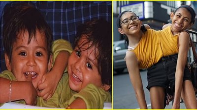 «تدرسان وأحدهما وقعت في الحب» قصة توأمتين ملتصقتين عمرهما 22 عامًا