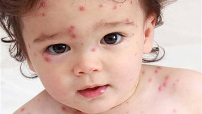 حالة من الرعب بعد ظهور أول حالة حصبة لطفل