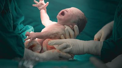 حالة من الرعب والجدل بعد ولادة طفل بعين واحدة