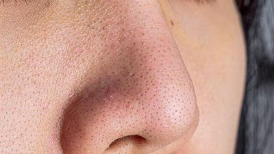 وصفات مذهلة لسد مسام وجهك الواسعة