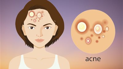 أسباب حبوب الوجه بحسب ظهورها في 5 مناطق وطرق العلاج