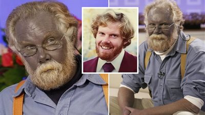 الرجل الأزرق| حكاية «بابا سنفور» وسر العلاج الخارق ومرض «أرجيريا»