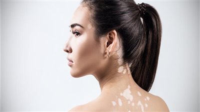 في يوم البهاق العالمي | الصحة تكشف أسباب المرض وطرق العلاج