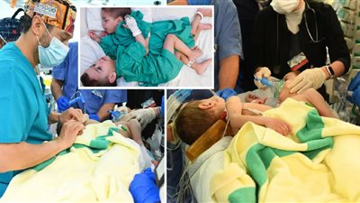 بتوجيهات خادم الحرمين| فصل التوأم السيامي السوري بسام وإحسان عبر جراحة 9 ساعات