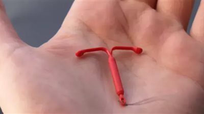 مزايا تركيب اللولب أثناء الولادة القيصرية «سهولة وأمان» (صور)