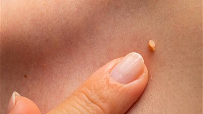 أعراض تدل على إصابتك بفيروس الورم الحليمي