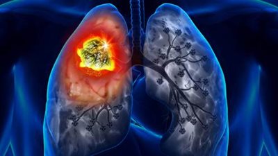الصحة تنشر 4 خطوات هامة للحماية من سرطان الرئة 