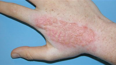 هل البول علاج فعال للسعة قنديل البحر؟.. طبيب يكشف الحقيقة  