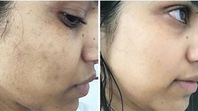 4 حيل مذهلة لإخفاء البقع الداكنة في وجهك باستخدام المكياج