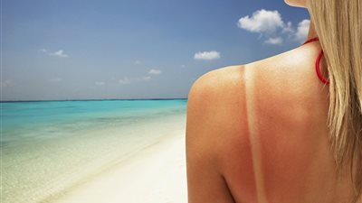 4 خطوات بسيطة لعلاج حروق الشمس في المنزل (انفوجراف)