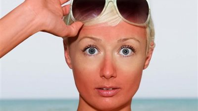 4 مكونات طبيعية لعلاج حروق الشمس في الصيف